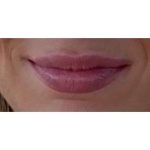 Lip Augmentation Before & After Patient #197