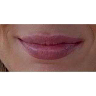 Lip Augmentation Before & After Patient #197