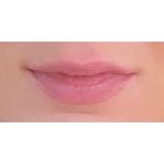 Lip Augmentation Before & After Patient #197
