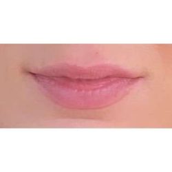 Lip Augmentation Before & After Patient #197