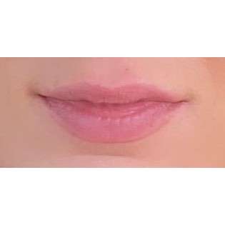 Lip Augmentation Before & After Patient #197