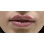 Lip Augmentation Before & After Patient #194