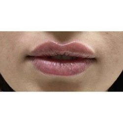 Lip Augmentation Before & After Patient #194