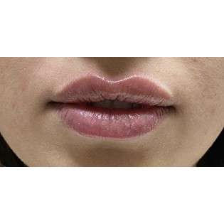 Lip Augmentation Before & After Patient #194