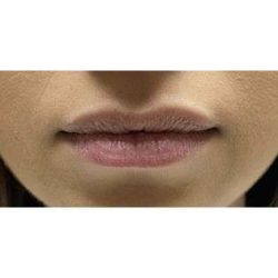 Lip Augmentation Before & After Patient #194