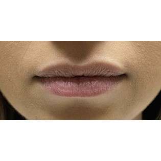 Lip Augmentation Before & After Patient #194