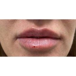 Lip Augmentation Before & After Patient #191