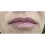 Lip Augmentation Before & After Patient #191