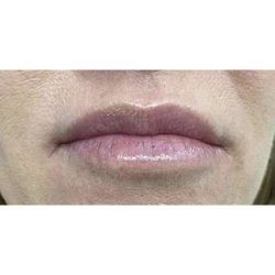Lip Augmentation Before & After Patient #191