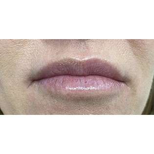 Lip Augmentation Before & After Patient #191
