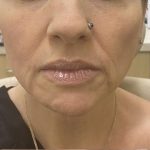 Filler Before & After Patient #1237