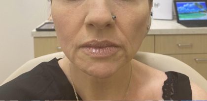Filler Before & After Patient #1237