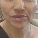 Filler Before & After Patient #1237