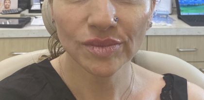 Filler Before & After Patient #1237