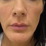Filler Before & After Patient #1239