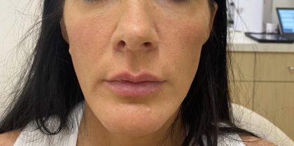 Filler Before & After Patient #1239