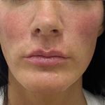 Filler Before & After Patient #1239