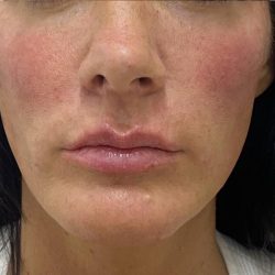 Filler Before & After Patient #1239