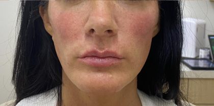 Filler Before & After Patient #1239