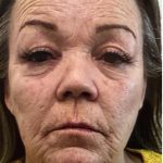 Filler Before & After Patient #1233