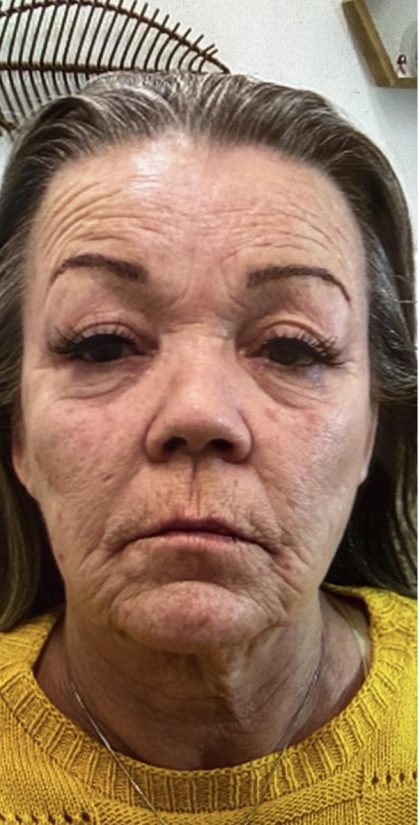 Filler Before & After Patient #1233