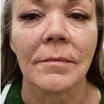 Filler Before & After Patient #1233