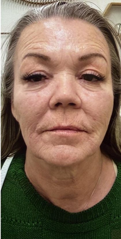 Filler Before & After Patient #1233