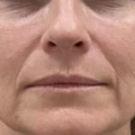 Filler Before & After Patient #1219