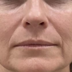 Filler Before & After Patient #1219