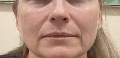 Filler Before & After Patient #1219