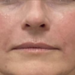 Filler Before & After Patient #1219