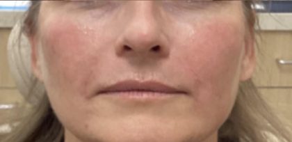 Filler Before & After Patient #1219