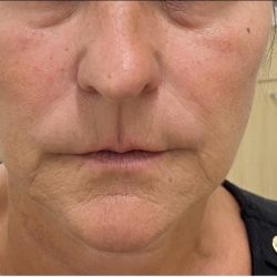 Filler Before & After Patient #1225
