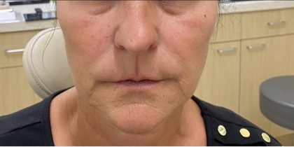 Filler Before & After Patient #1225