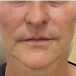 Filler Before & After Patient #1225