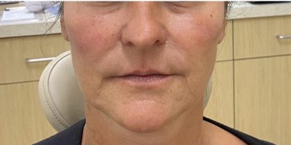 Filler Before & After Patient #1225