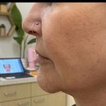 Filler Before & After Patient #1220