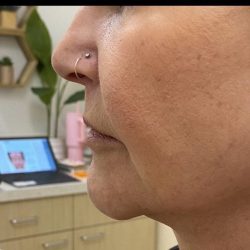 Filler Before & After Patient #1220
