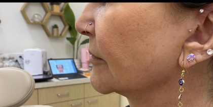 Filler Before & After Patient #1220