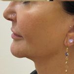 Filler Before & After Patient #1220