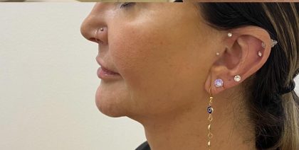 Filler Before & After Patient #1220