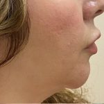 Filler Before & After Patient #1223