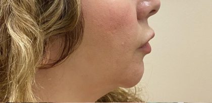 Filler Before & After Patient #1223