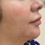 Filler Before & After Patient #1223