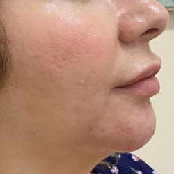 Filler Before & After Patient #1223
