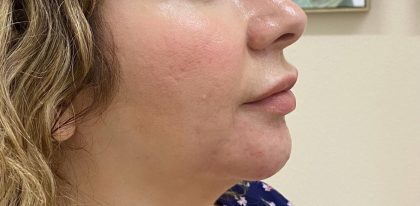 Filler Before & After Patient #1223