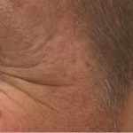 Botox Before & After Patient #1230