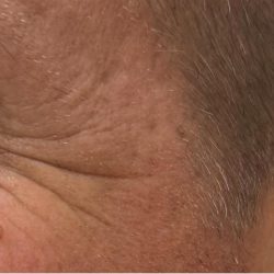Botox Before & After Patient #1230