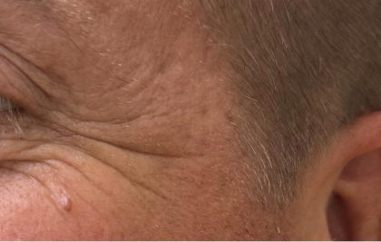 Botox Before & After Patient #1230