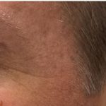 Botox Before & After Patient #1230